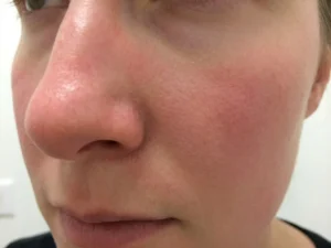 Vrouwenwang met subtiele roze blos rond neus en jukbeenderen tegen witte klinische achtergrond